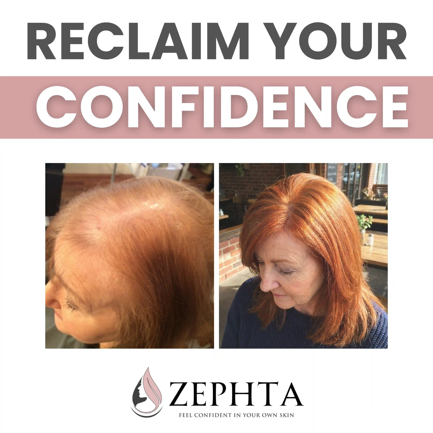 Reclaim your confidence - before and after with Zephta H-Regrow 3.0