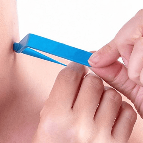 Zephta® Skin Tag Remover