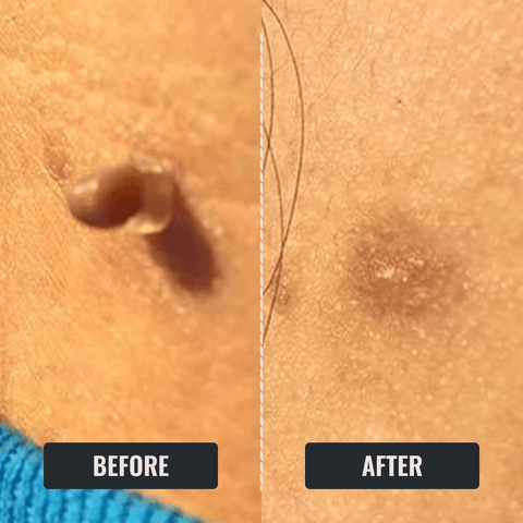 Zephta® Skin Tag Remover